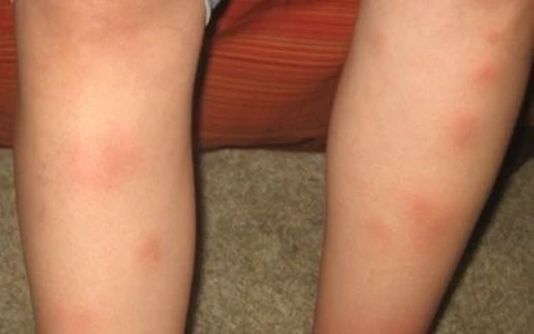 Khám phá hình ảnh hồng ban đa dạng ở trẻ em dễ nhận biết