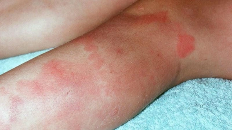 Hướng dẫn cách chữa bệnh hồng ban đa dạng an toàn tại nhà