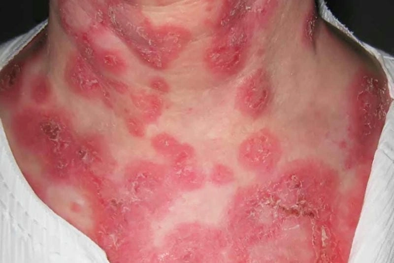 Hiểu rõ bệnh hồng ban đa dạng và dấu hiệu nhận biết sớm