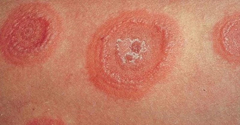 Tìm hiểu nguyên nhân hồng ban đa dạng và cách phòng tránh