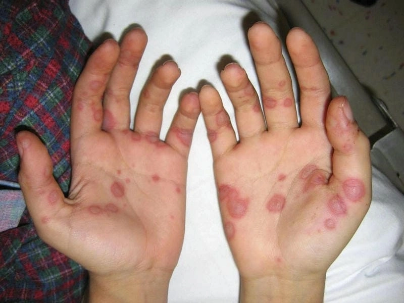 Giải đáp bệnh hồng ban đa dạng có lây không chính xác