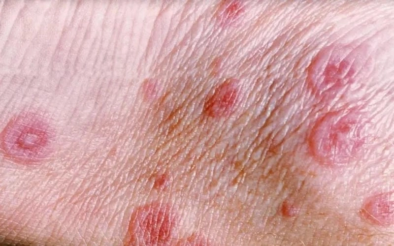 Nhận diện triệu chứng hong ban da dang dễ hiểu nhất