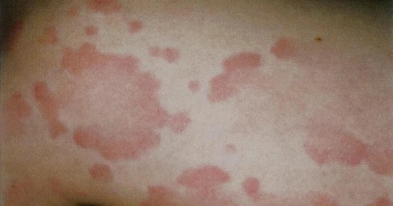 Thông tin hồng ban đa dạng có lây không bạn nên biết