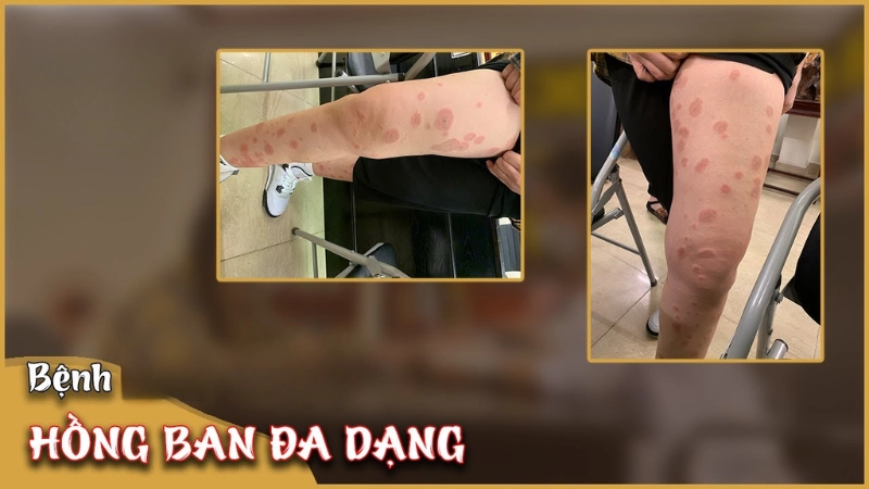 Hình ảnh bệnh hồng ban đa dạng là như thế nào