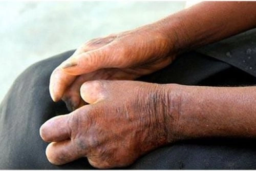 Thực trạng bênh phong hủi qua từng giai đoạn