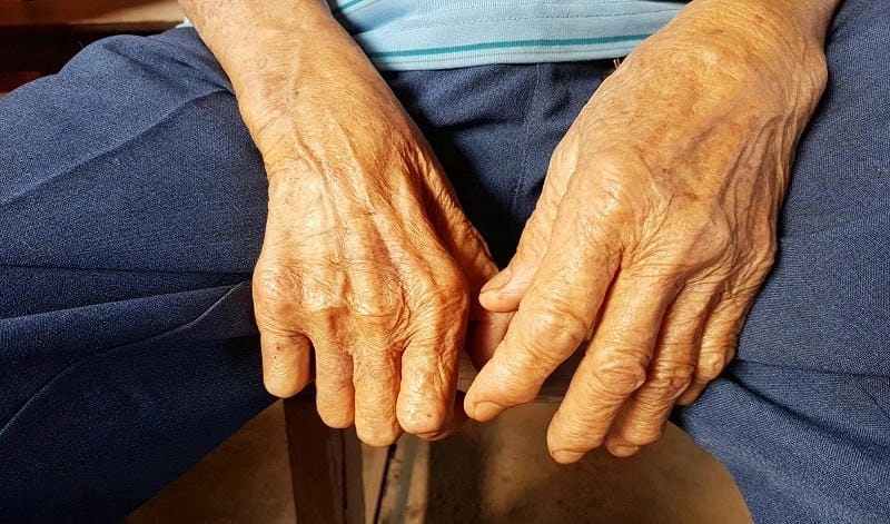 Xem ảnh rồi hỏi bệnh hủi có chữa được không