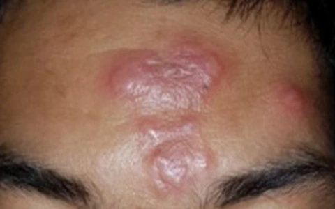 Chiêm ngưỡng rõ nét hình ảnh bệnh hủi thực tế