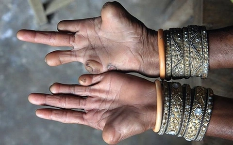 Diễn biến nguy hiểm của bệnh hủi qua ảnh