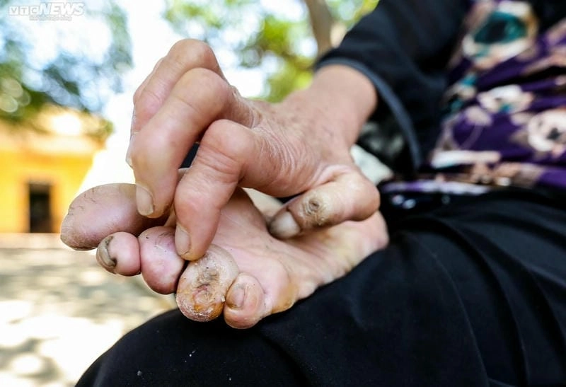 Toàn cảnh phong hủi từ triệu chứng đến hậu quả