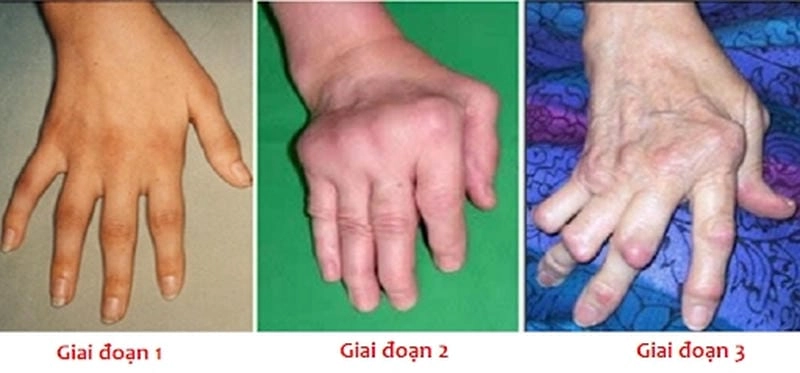 Tìm hiểu rõ về bệnh hủi qua ảnh thực tế