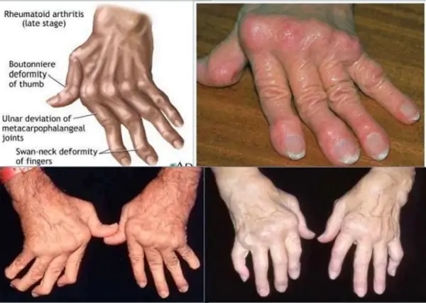 Cảnh báo ban đầu từ dấu hiệu bệnh hủi cụ thể