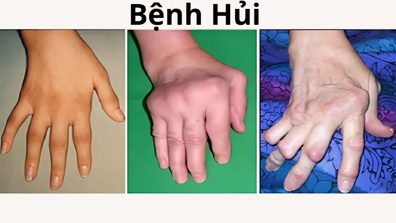 Hình ảnh bệnh hủi là như thế nào ngoài đời thật 