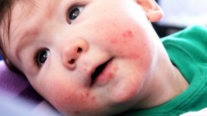 Ảnh mô tả triệu chứng bệnh kawasaki ở người lớn