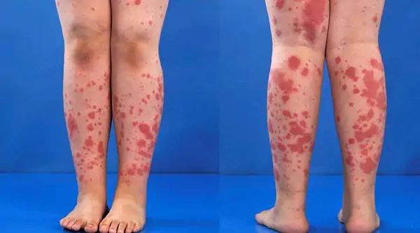 Ảnh lâm sàng kawasaki ở người lớn tuổi dễ hiểu