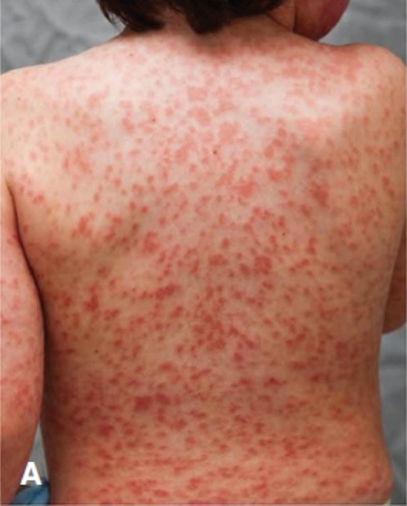 Bộ ảnh cảnh báo bệnh kawasaki người lớn nguy hiểm