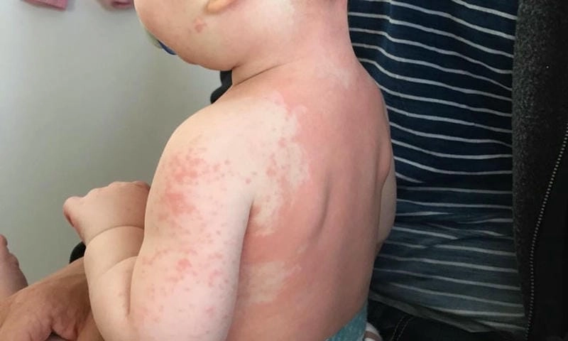 Bộ ảnh lâm sàng bệnh kawasaki ở trẻ em dễ hiểu