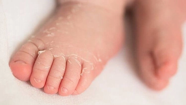 Ảnh hình nhận biết dấu hiệu bệnh kawasaki chính xác