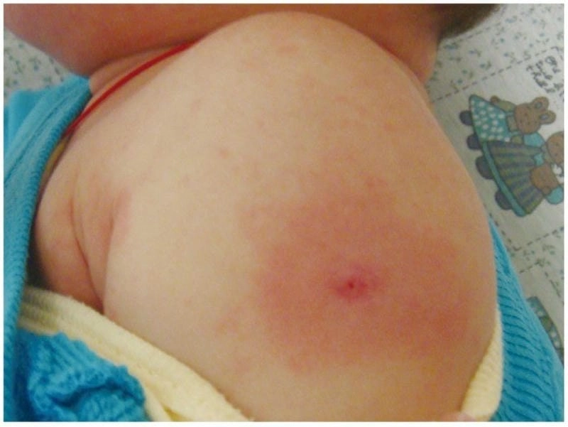 Xem ảnh hướng dẫn chẩn đoán kawasaki trực quan