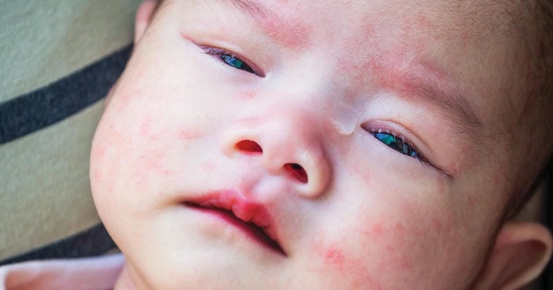 Ảnh hình mô phỏng kawasaki ở trẻ em dễ nhận biết