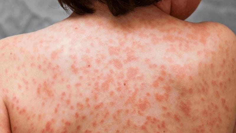 Xem ngay ảnh thật về bệnh kawasaki gây chú ý