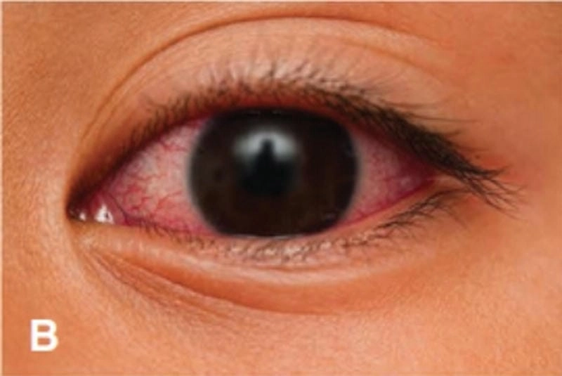 Ảnh nhận biết sớm dấu hiệu sốt kawasaki