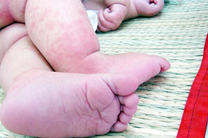 Tổng hợp ảnh biểu hiện sốt nhật bản kawasaki