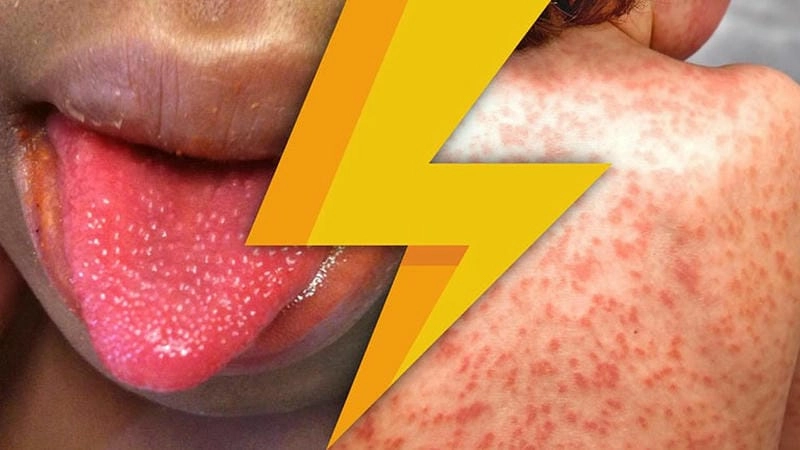 Cập nhật ảnh phác đồ điều trị bệnh kawasaki