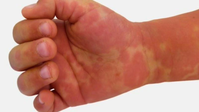 Loạt ảnh mô tả bệnh kawasaki không điển hình rõ ràng