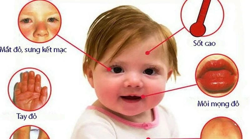 Ảnh tổng hợp về bệnh kawasaki ở việt nam đáng chú ý