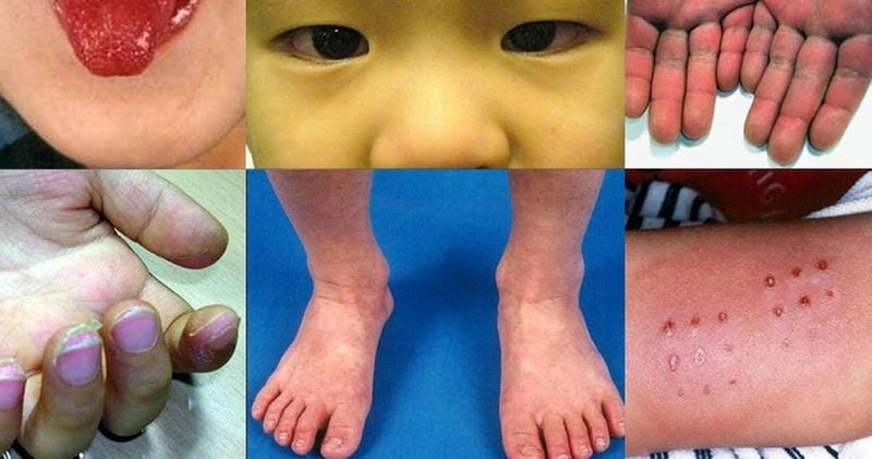 Tổng hợp ảnh thực tế về kawasaki bệnh lâm sàng