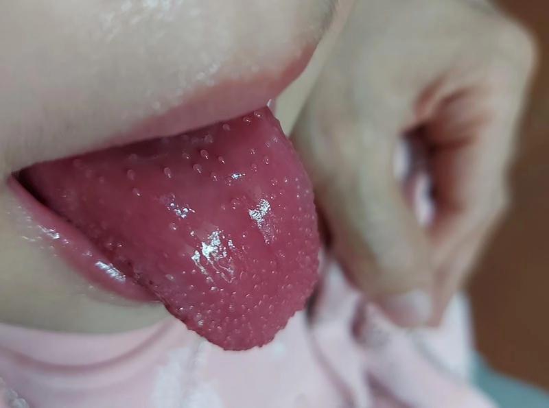 Xem ảnh chi tiết về bệnh kawasaki bệnh học