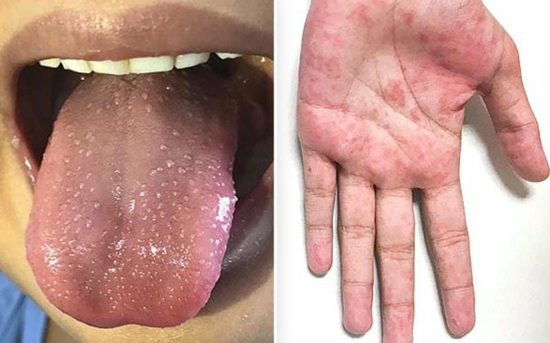 Ảnh minh họa chuẩn về bệnh kawasaki trẻ em