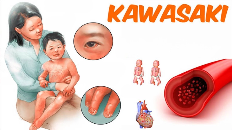 Triệu chứng bệnh kawasaki là như thế nào