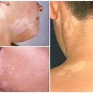 Phân biệt bệnh lang beng ở trẻ nhỏ và hăm da