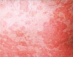 Tổng hợp ảnh người bị lang beng thực tế