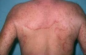 Dấu hiệu đặc trưng ở người bị bệnh lang beng