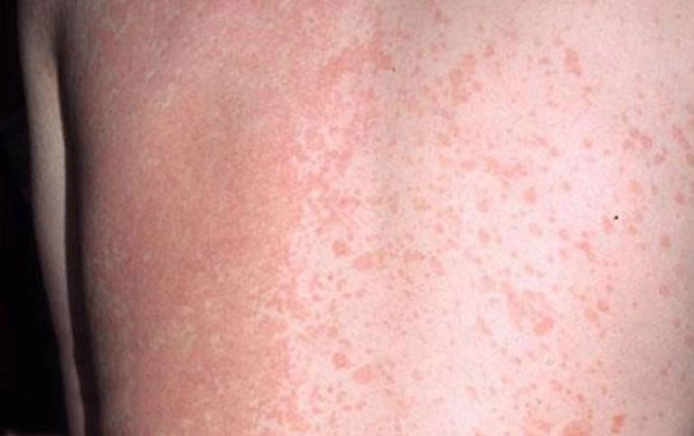 Tổng hợp các hình ảnh bị lang beng điển hình