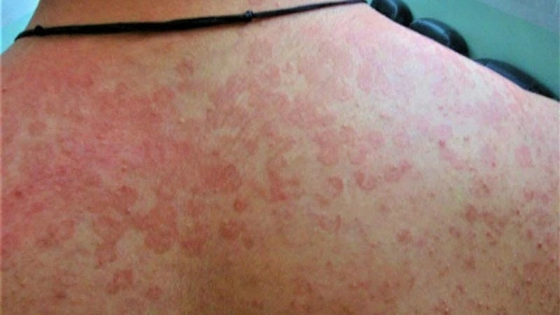 Lý do khiến bạn bị lang beng trắng ở mặt