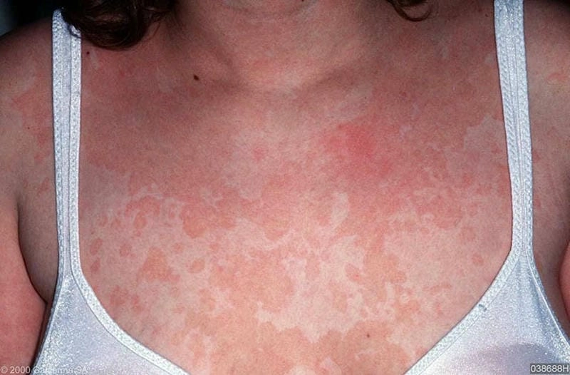 Hướng dẫn an toàn áp dụng cách trị lang beng đỏ