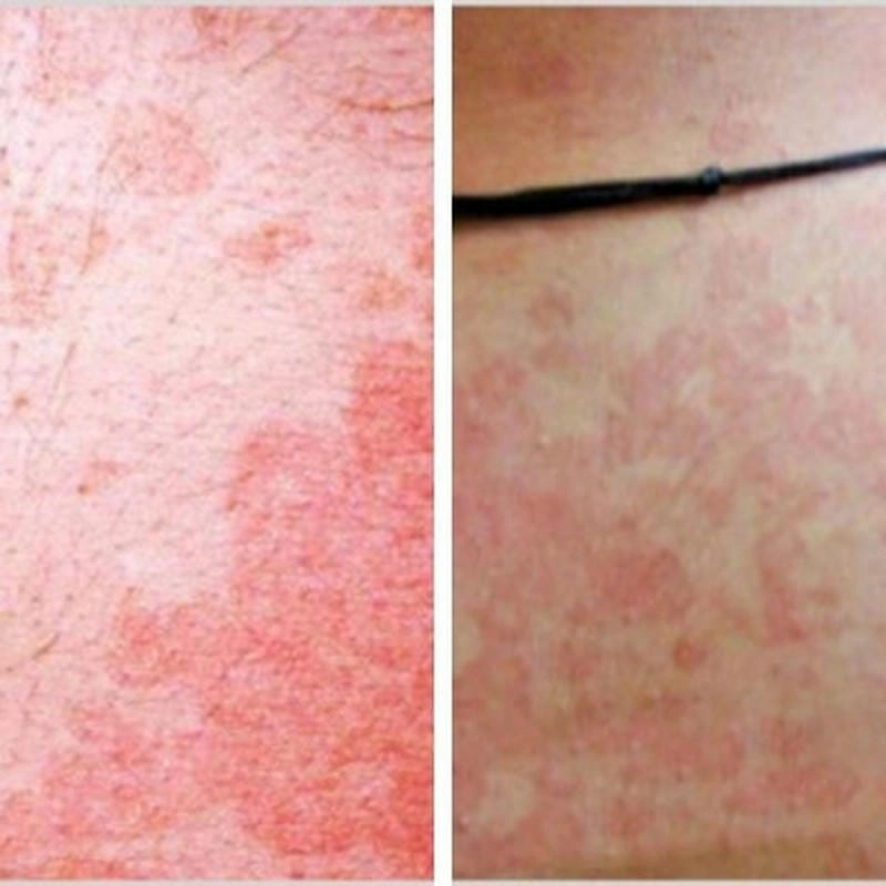 Đốm trắng khó chịu khi bị lang beng ở mặt