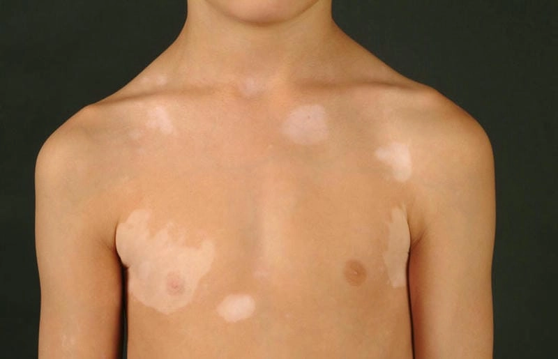 Biểu hiện phổ biến khi bị lang beng ở lưng