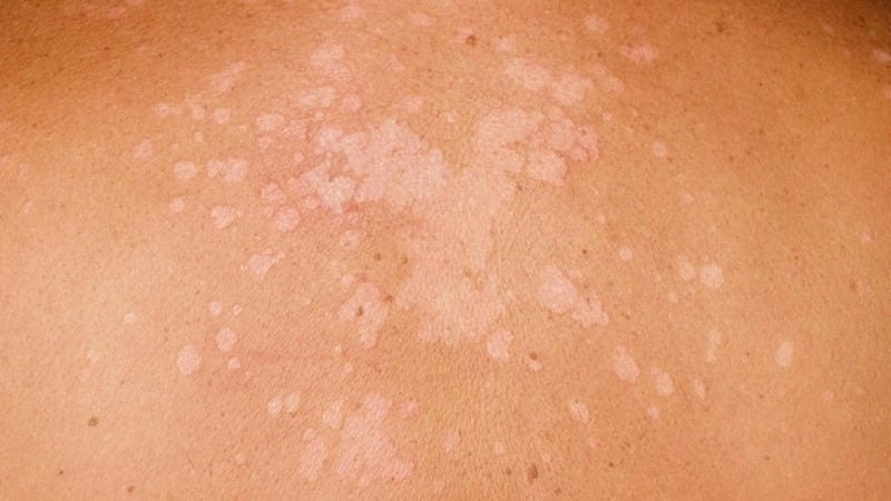 Chọn loại thuốc chữa lang beng đỏ được khuyên dùng