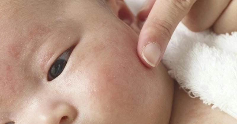 Điểm danh các thuốc trị lang beng đỏ phổ biến