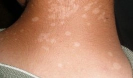 Nhìn rõ triệu chứng qua hình ảnh người bị bệnh lang beng đỏ