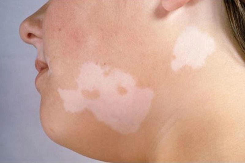 Xem ngay bộ sưu tập ảnh bệnh lang beng đỏ chân thực