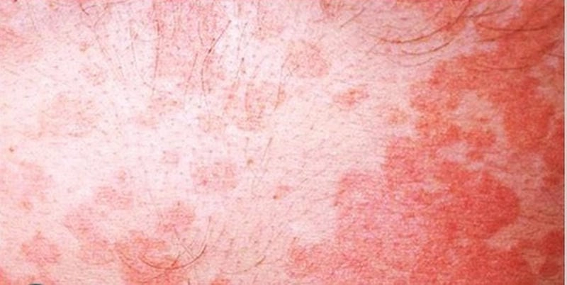 Triệu chứng thường gặp khi bị lang beng