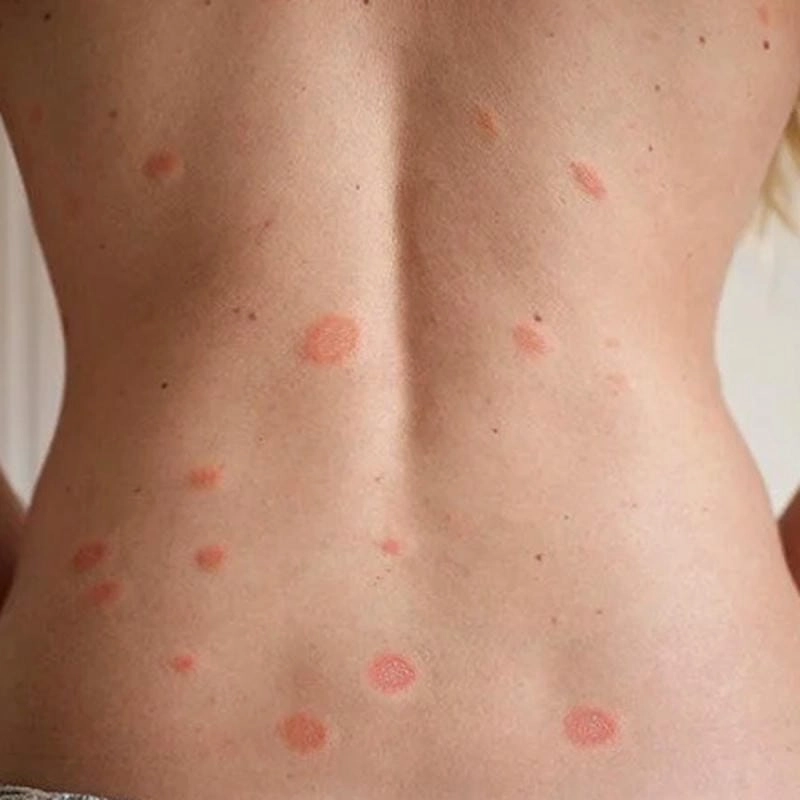 Da nổi mẩn từng vùng do lang beng đỏ