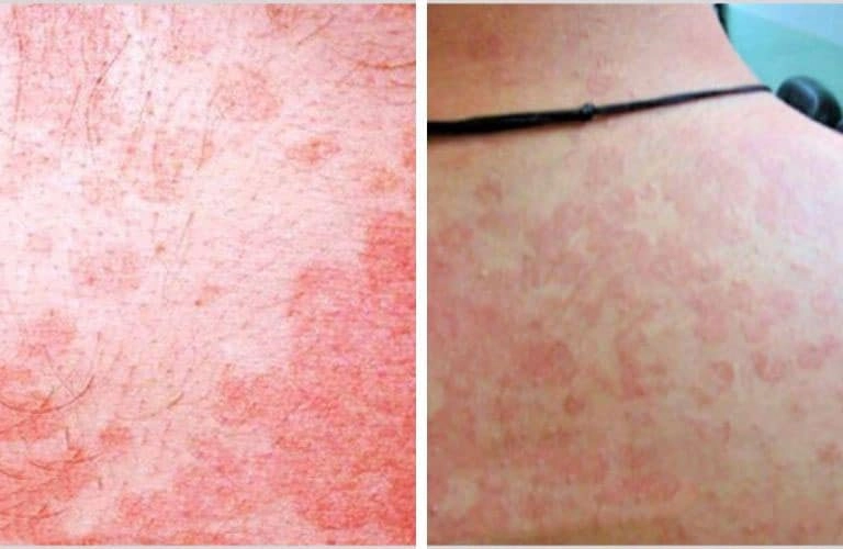 Nhận biết nhanh hình ảnh bị lang beng