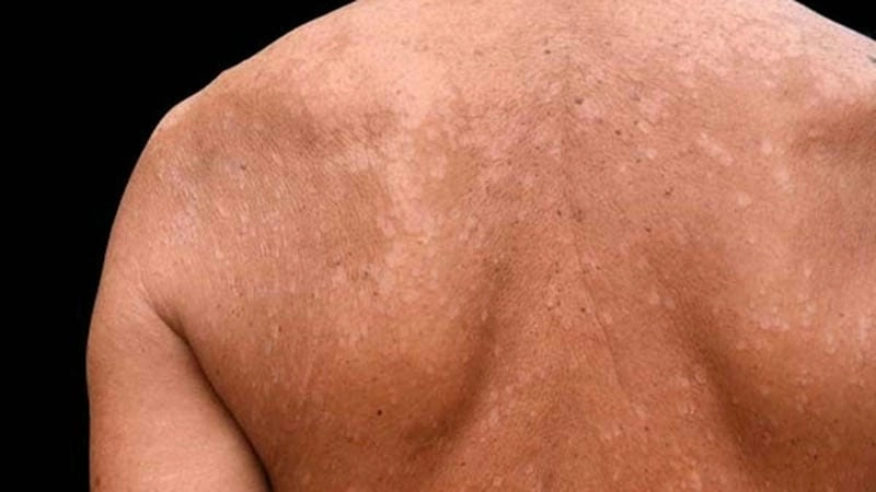 Tình trạng bị lang beng trắng lan rộng