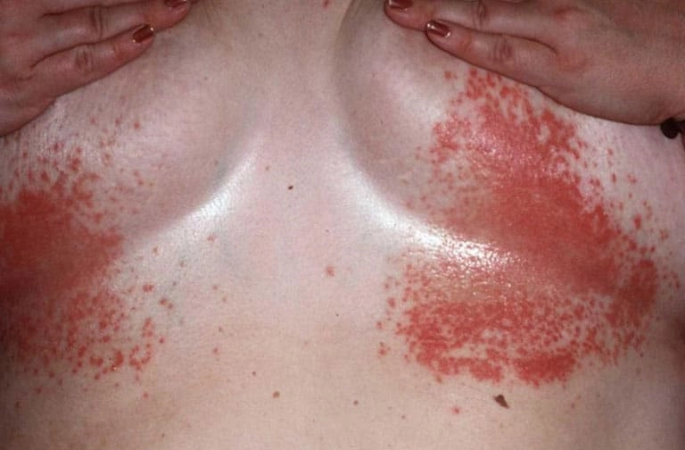 Cách xử lý khi bạn bị lang beng